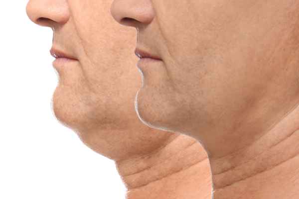 HIFU - Breakthrough in Anti - ageing 2 hifu results Harwich