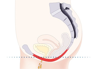 Pelvic-Floor Muscle Repair 5 Pelvic floor muscles Harwich