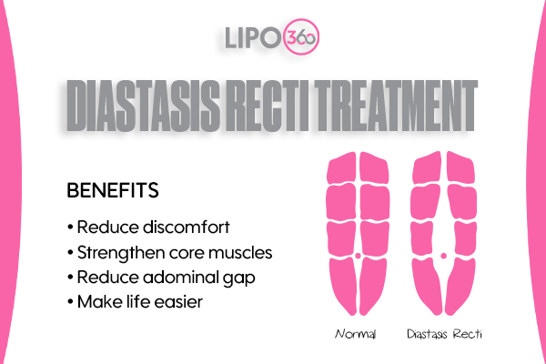 Revolutionising Muscle Repair: The Power of LIPO360 Body Sculpt Post-Injury 5 diastasis recti treatment Harwich
