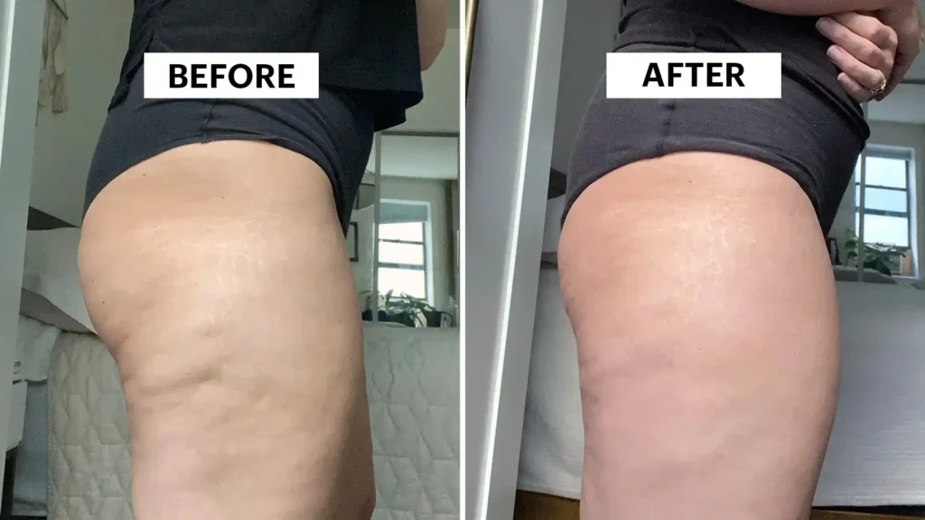 Sculpting Your Bum: Can Toning Exercises Really Reduce Cellulite? 1 Do Toning Exercise Harwich Really Tackle Cellulite?