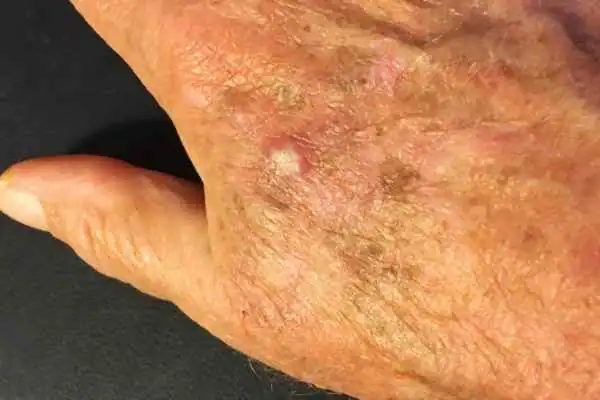 Cryopen For Actinic Keratoses 1 Image of Actinic keratoses Harwich on a person hand