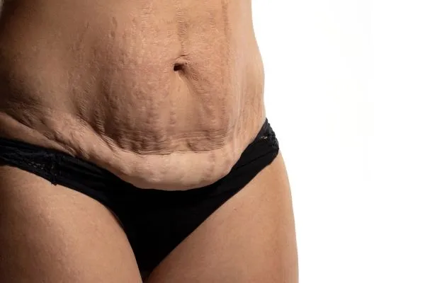 The science behind skin tightening Harwich picture of a woman's sagging skin on the stomach